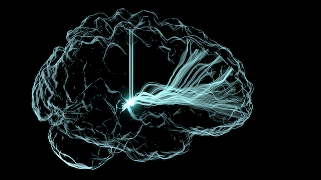 Seizures in the brain. Credit: Andrew Janson, Butson Lab, University of Utah. Permission to use/share photo from https://www.flickr.com/photos/nihgov/48488718106